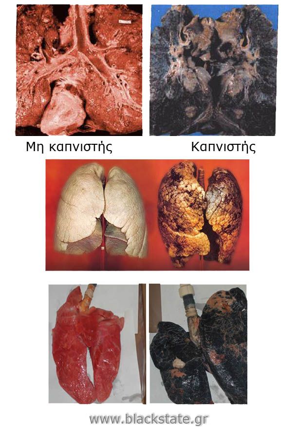 Πνεύμονες καπνιστών